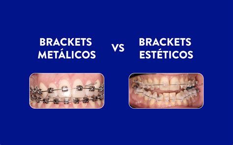 diferencias entre brackets metalicos y esteticos|Brackets Estéticos: Todo Sobre los Brac.